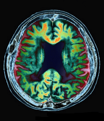 Image: Colored magnetic resonance imaging (MRI) scan of a section through the brain of a 68-year-old patient suffering from Alzheimer’s disease (photo courtesy of Zephyr).